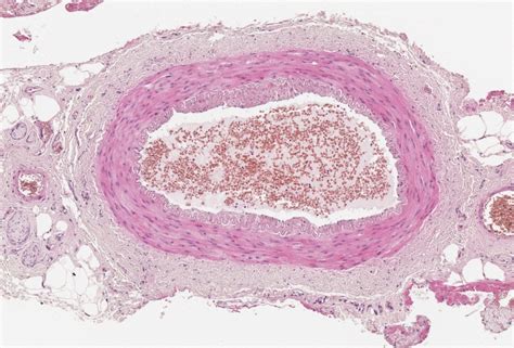 Normal temporal artery histology - GCA Histology