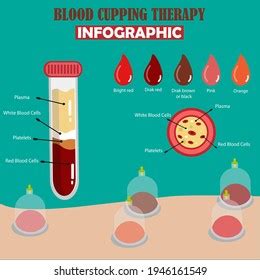 Blood Cupping Therapy Infographic Vector Stock Vector (Royalty Free ...