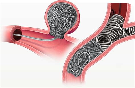 Coil Embolization: A Closer Look at the Procedure - Doctor Imtiaz Ahmad