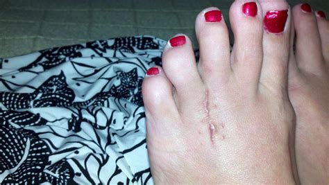 Morton's Neuroma Surgery Recovery: Ten Weeks Post-Op