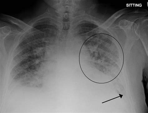 Pulmonary edema - Wikipedia