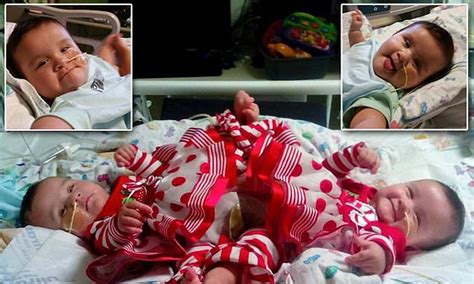 Rare conjoined twin sisters born in a set of triplets are successfully separated after mammoth ...