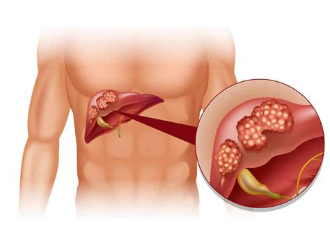 The Symptoms, Causes and Treatment for Liver Cysts