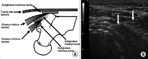 Ultrasound Guided Psoas Bursa Injection Youtube