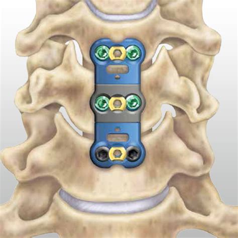 Intradural Cervical Disc Herniation