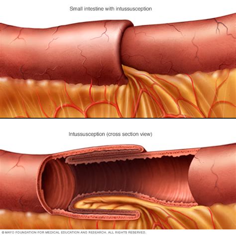 Solitary rectal ulcer syndrome Disease Reference Guide - Drugs.com