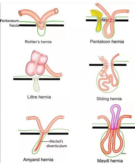 Types of Hernia - MEDizzy