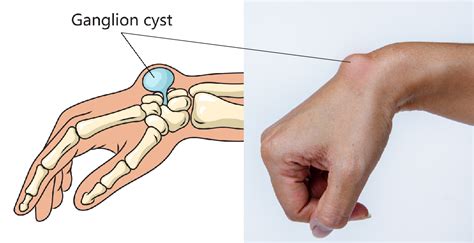 Ganglion and Mucous Cysts - Golden State Orthopedics & Spine