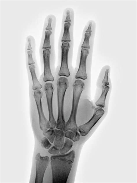 Normal Hand X-ray Of A 15 Year Old Boy Digital Art by Callista Images - Fine Art America