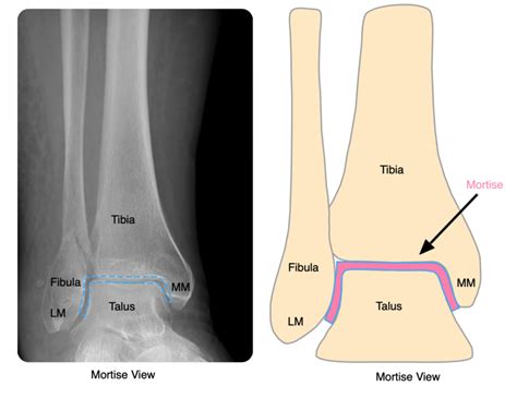 Ankle Mortise