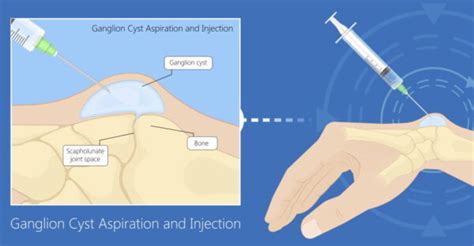 Ultrasound-Guided Aspiration of Ganglion Cyst: Explained