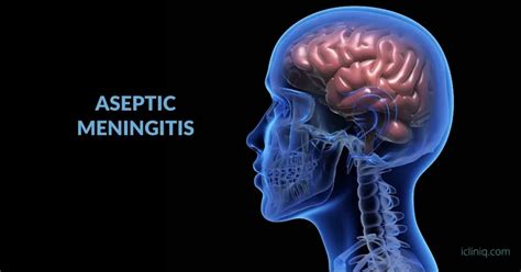 Aseptic Meningitis - Causes | Symptoms | Diagnosis | Treatment