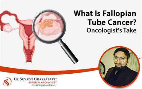 What Is Fallopian Tube Cancer?-Oncologist's Take