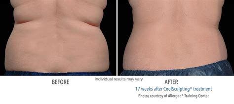 CoolSculpting Elite Before and After | New Treatment and Better Results