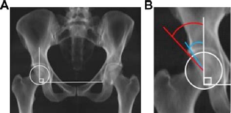 Relationship Between the Lateral Center-Edge Angle and 3-Dimensional Acetabular Coverage ...