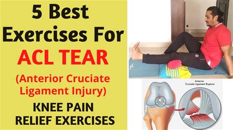 ACL Injury Partial Tear Treatment | ACL Grade 2, Rehab Exercises ...