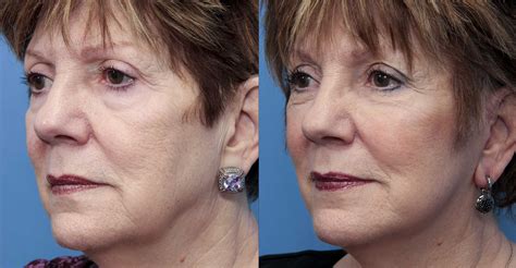 What is a mini-facelift? | Blog | Mount Airy, Maryland Plastic Surgery