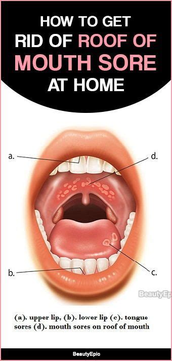 5 easy ways to get rid of roof of mouth sore at home – Artofit