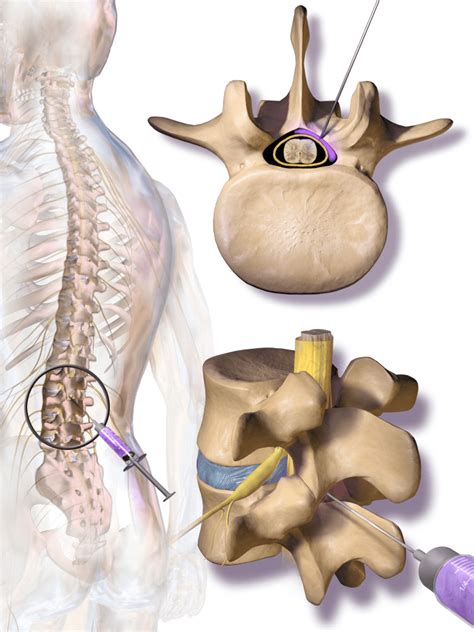 Epidural Steroid Injection | Bone and Spine