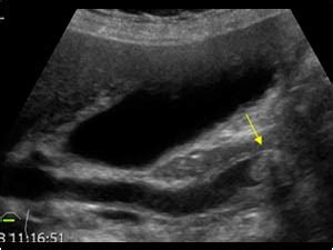 Abdomen and retroperitoneum | 1.2 Gallbladder and bile ducts : Case 1.2 ...