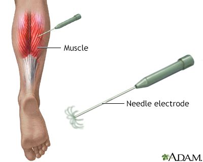 Electromyography Information | Mount Sinai - New York