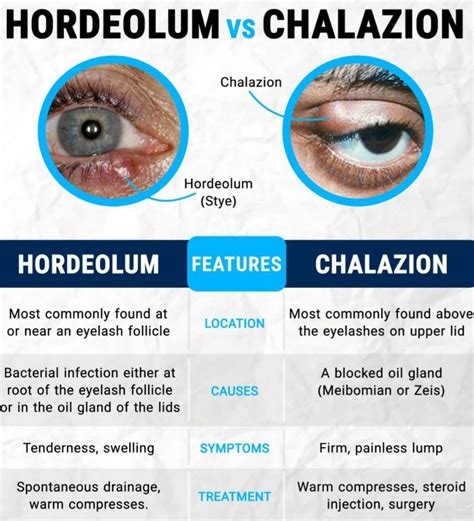 Hordeolum Vs Chalazion - Yemen Egyptian Pharma .Ltd