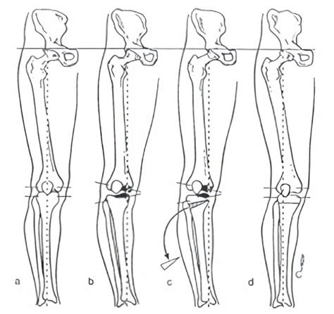 Knee Osteotomy | Sydney Orthopaedic Trauma & Reconstructive Surgery