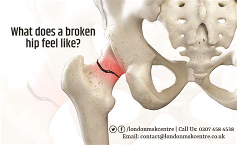 broken hip - London Musculoskeletal Centre | Orthopedic & Sports Medicine