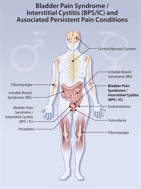 The Blamed Bladder | HealthPlexus.net