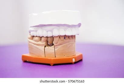 Jaw On Tablewhite Backgroundteeth Prosthesis On Stock Photo 570675121 | Shutterstock