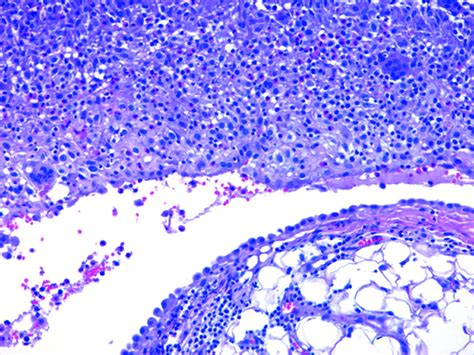 Malignant Pleural Mesothelioma Pathology