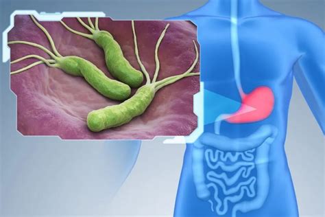 Helicobacter Pylori Infection: Symptoms and Complications - G & L Surgical