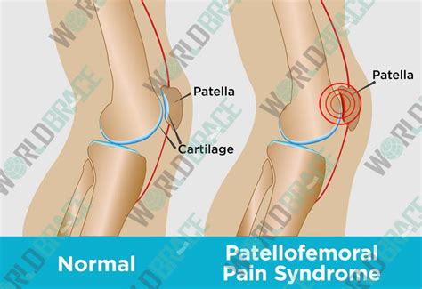 What Is Patellofemoral Pain Syndrome (PFPS)? - WorldBrace