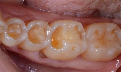 Diagnosing Tooth Wear: Attrition Versus Erosion - Restorative Nation