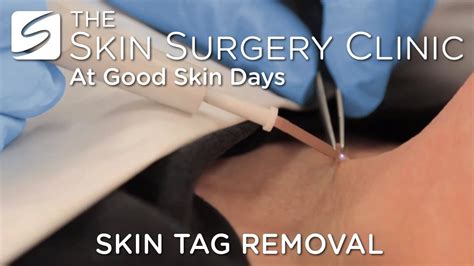 Videos - Skin Surgery Clinic