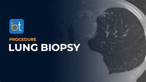 Lung Biopsy Procedure | BackTable VI