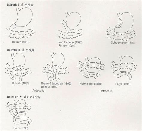 Various reconstructive procedures after partial gastrectomy (Ref. 16 ...