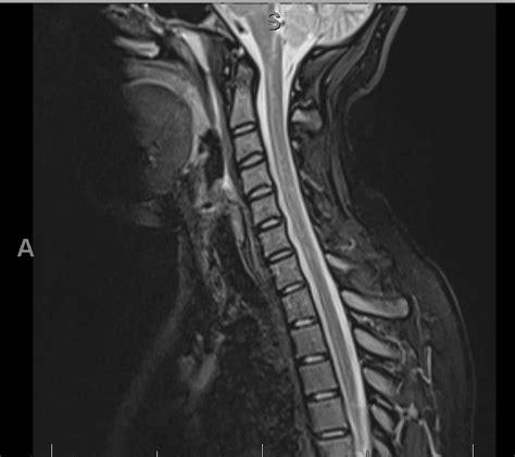 Cureus | Guillain-Barre Syndrome Associated With COVID-19 Infection: A ...