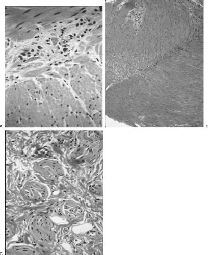 Hirschsprung’s Disease | Obgyn Key