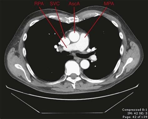 Venous Anatomy of the Thorax | Radiology Key