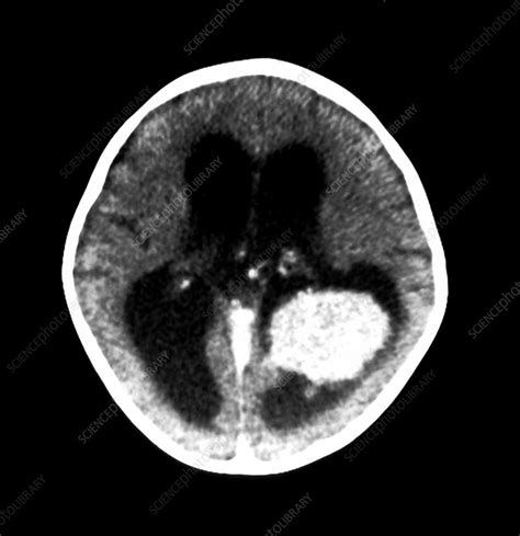 Choroid Plexus Papilloma - Stock Image - M240/0723 - Science Photo Library