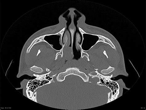 Rhabdomyosarcoma CT - wikidoc