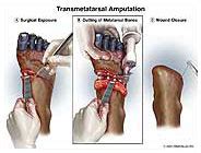 Toe Amputation - MediVisuals