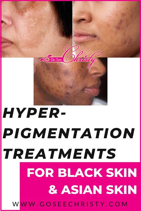 Hyperpigmentation Treatments for Dark Skin: Black Skin Asian Skin and ...