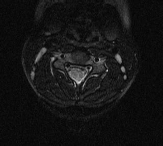 Cervical Dermal Sinus-MRI - Sumer's Radiology Blog