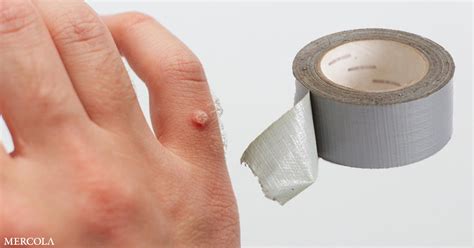 How to Remove Warts With Duct Tape - nccRea