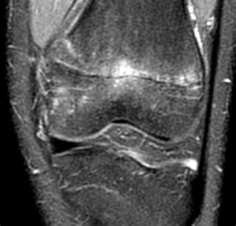 Salter-Harris Fractures | Radsource