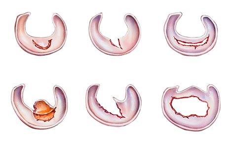 6 Types of Meniscus Tears and Locations