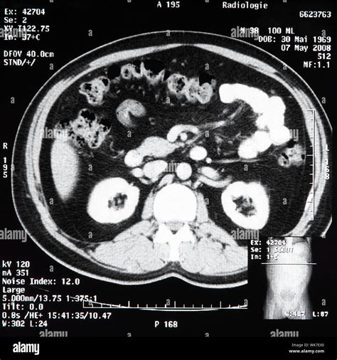 Ct scan abdomen hi-res stock photography and images - Alamy