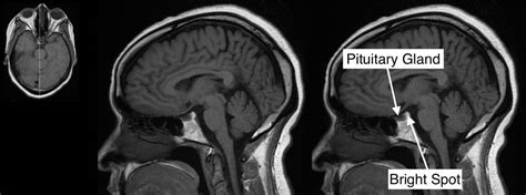 Pituitary Gland Mri Anatomy